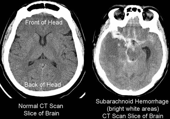 16 KUVA 4. Vasemmanpuoleisessa kuvassa aivojen normaali tila ja lukinkalvonalainen verenvuoto (SAV) havaittavissa oikeanpuoleisessa CT-kuvassa (UW Medicine N.d.b) 3.