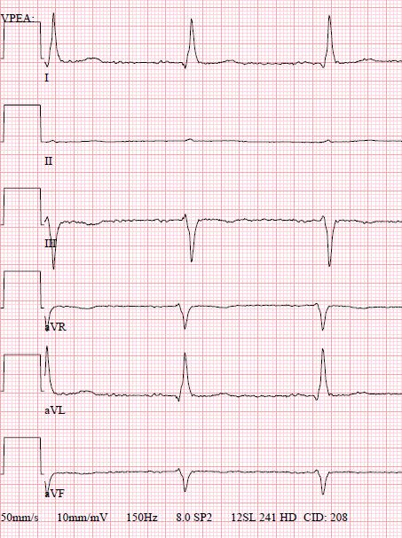 RA/ RL reversal Lead II records a flat line (zero potential) Lead I becomes