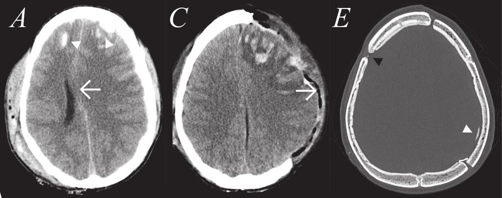 Fig. 3. Disease course of TBI, skull base fractures, DC, cranioplasty and a postoperative epidural haematoma imaged with CT.