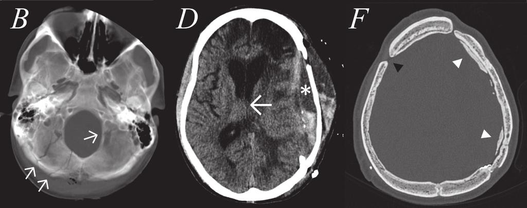Diffuse contusional blood foci within the brain were noted. In B, skull base fractures are visible (arrows). In C, DC was conducted (arrow) and decompression achieved.