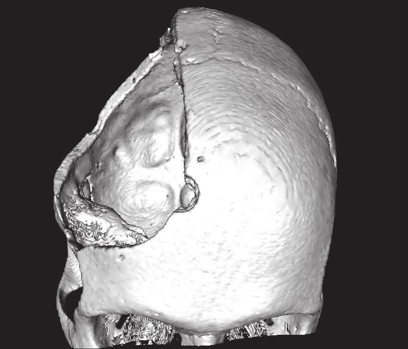 The bone flap was affixed to the cranium using double-sided clamp systems, and a perfect fit to the recipient site was achieved (D).