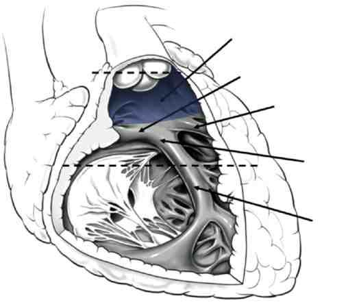 ARVD has a poor prognosis and often requires an implantable cardioverter-defi brillator to protect against sudden death. Distinguishing RVOT tachycardia from ARVD is extremely important.