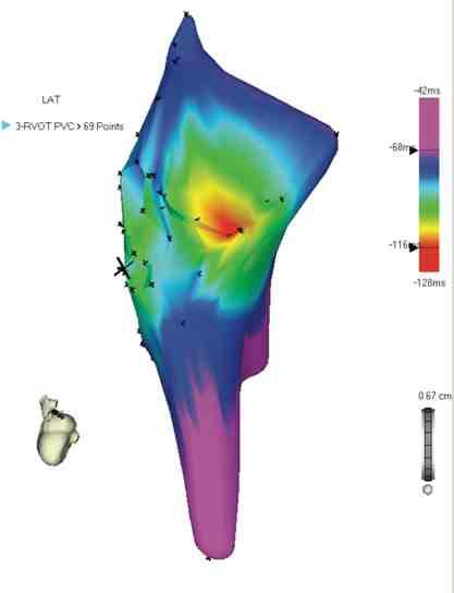 PVCs arising from the RVOT are not always benign.