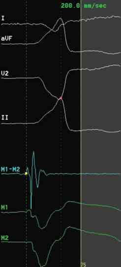 Patients with ARVD may have ventricular arrhythmias originating from the RVOT, masquerading as idiopathic outflow tract VT.