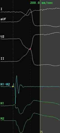 Patients with ARVD may have ventricular arrhythmias originating from the RVOT, masquerading as idiopathic outflow tract VT.