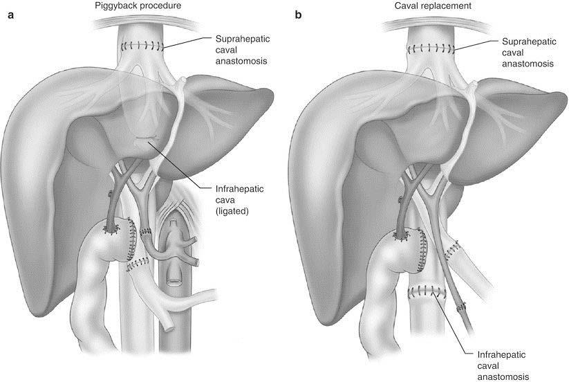 Figure 3. Piggyback approach (left) in which donor s suprahepatic vena cava is sewn to recipient s hepatic veins and donor s infrahepatic vena cava is closed. Conventional (i.e. caval replacement) approach (right) in which donor s suprahepatic and infrahepatic vena cava is sewn to recipient s suprahepatic and infrahepatic vena cava, respectively.