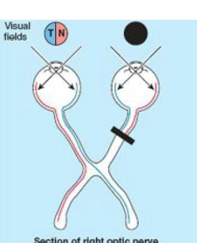 hemianopsia KUVA 1 - NÄKÖHERMON LEESION SIJAINNIN VAIKUTUS NÄKÖKENTTÄÄN: