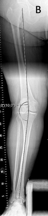 ed with the progression of knee OA (Sharma, et al. 2001, Felson, et al. 2005, Sharma. 2007, Eckstein, et al. 2009, Khamaisy, et al. 2015). Figure 1.