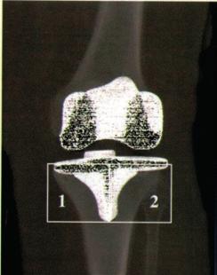 diaphyseal, (5) metaphyseal