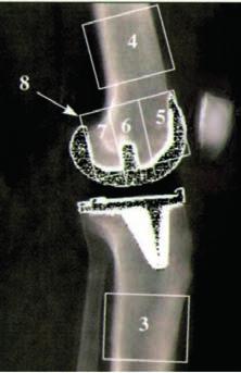 posterior and (8) total