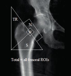 Ward s (W), trochanter (TR),