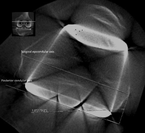 Figure 6. Determination of femoral component rotation in an axial cone beam computed tomography (CBCT) image.