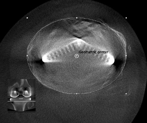 condyles of the component. The component shown here is in 1.0 of internal rotation relative to the surgical epicondylar axis. A B C Figure 7. Determination of the tibial component rotation.