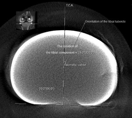 The anteroposterior tibial component axis (T.C.A.) was drawn perpendicular to the posterior surface of the component. The angle between the tibial anatomic axis and the T.C.A. was measured to determine the rotation of the component.