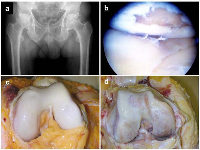 Ulcerated cartilage is troublesome thing... once destroyed it is not repaired.