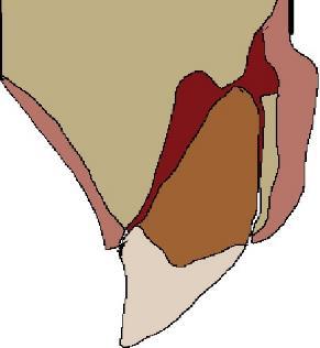 Aksiaalisesti hammas on edelleen normaaliasennossa ja alveolikuopassa ei esiinny murtumia. Parodontaaliligamentit voivat olla osittain tai kokonaan irronneet hampaasta (Andreasen JO ym. 2007).