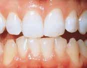 Sitä käytetään hammaslääkärin muotoilemilla ja potilaan hymyyn räätälöidyillä valkaisulusikoilla.
