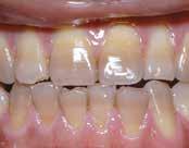 Se on vaihtoehtoinen, perinteisempi tummuneiden, sisältäpäin värjäytyneiden hampaiden hoitomenetelmä (verrattuna kruunuihin, laminaatteihin jne.).