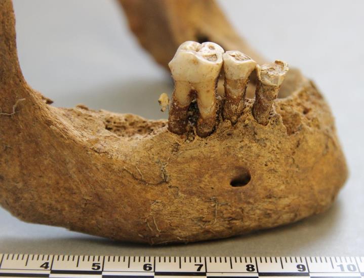 Hauta 19. Iänmääritys: adultus/maturus Sukupuolen arviointi: nainen Pituusarvio: n. 151 cm Patologiat/poikkeavuudet: vainajan oikeanpuoleisessa olkaluussa on proksimaalipäässä hieman osteofyyttejä.