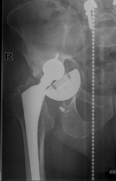 Radiologisia löydöksiä - muovin kuluma - osteolyysi - kirkastumalinjat - komponenttien asennon muutokset - implantin