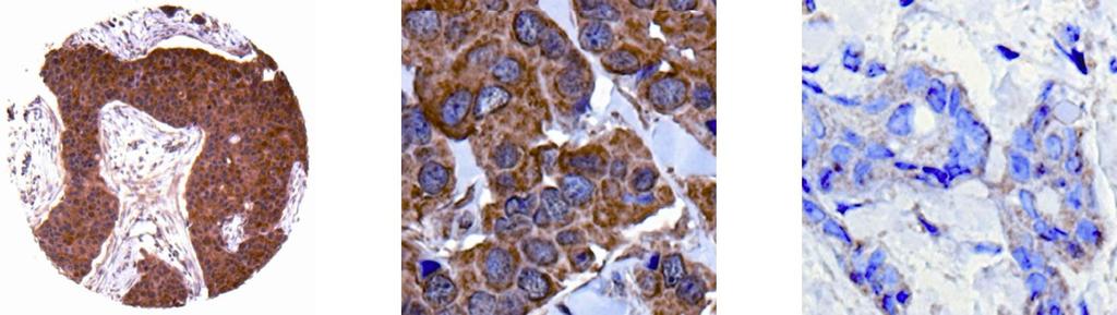 levels. Finally, no statistically significant association was detected between BMP7 mrna or protein status and clinicopathological parameters. A B C Figure 3.