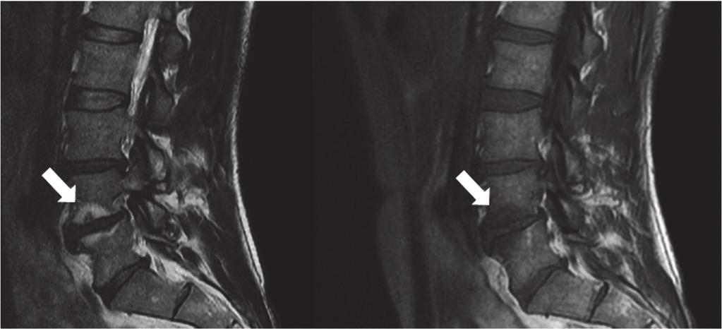 Fig. 5. MC1 on MRI.