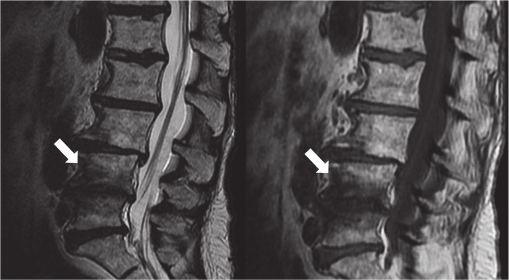 Fig. 7. MC3 on MRI. MC3 show decreased signal intensity on T1w (arrow) (right) and decreased signal intensity on T2w (arrow) (left) image.