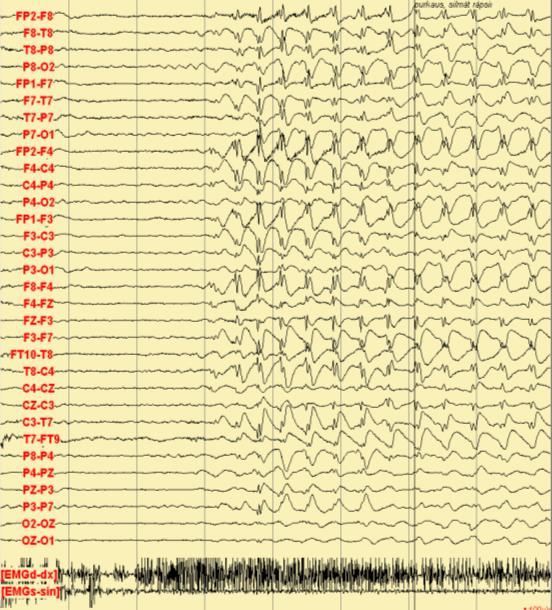 EEG:tä