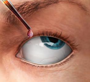 Silmän dilataatio ennen injektiota ei ole tarpeen.