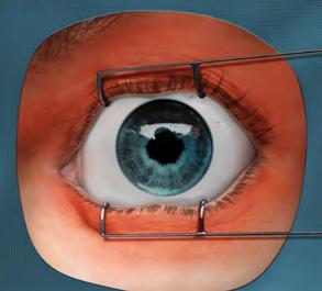 6 Pistä injektioneula lasiaiseen välttäen horisontaalista meridiaania ja tähdäten silmämunan keskikohtaan, ja injisoi 0,05 ml:n tilavuus.