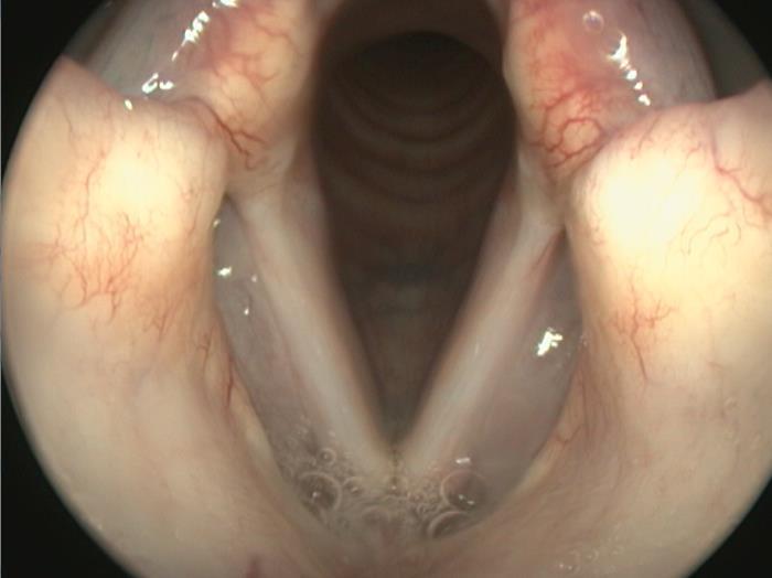 dysfunction of the larynx, the dogs are predisposed to aspiration pneumonia. Laryngeal paralysis can be congenital or acquired.