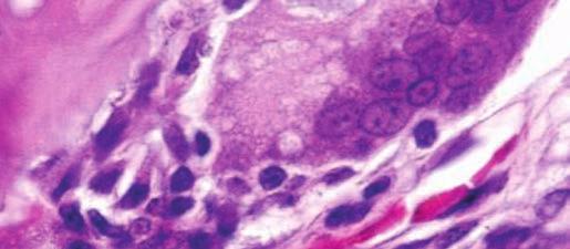 Source: Courtesy of Prof Ulf Nannmark, University of Göteborg, Sweden Part of a biopsy showing newly formed bone after treatment with OsteoBiol Putty. Htx-eosine.