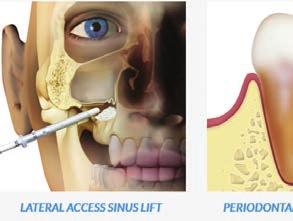 Clin Impl Dent Rel Res, 2012 Jun;14(3):373-9 OsteoBiol luumatrix edistää osteoblastien erilaistumista
