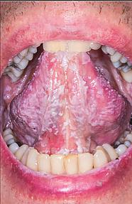 Tavallisia oireita ovat suupolte, paha maku ja epämukava tunne suussa. Hiivasienet muodostavat biofilmin ja asettuvat mielellään uusiutumattomille pinnoille (hammas, proteesit, muut vierasesineet).