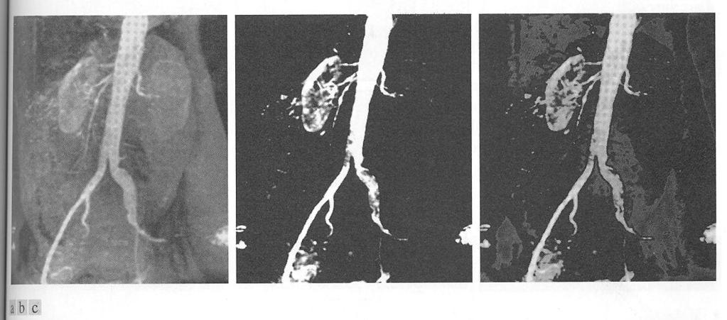 Kuva 3.9. (a) Aorttakuva, (b) viipalointimuunnoksen tulos kuvan 3.8.