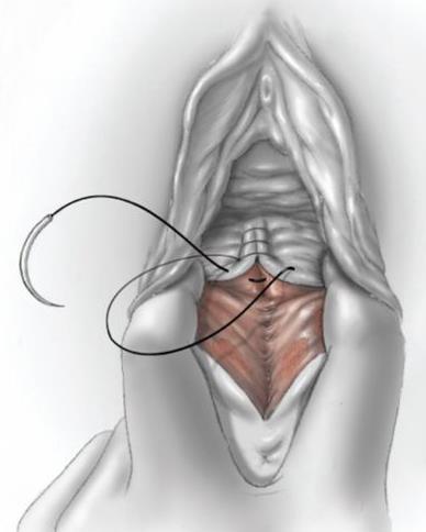 Vaginan limakalvon sulku Sulava 2-0 tai 3-0 lanka Knopit tai jatkuva ommel Tarvittaessa reunojen siistiminen / limakalvon resektio (esim. rafioissa) Riittävän syvät ompeleet ns.