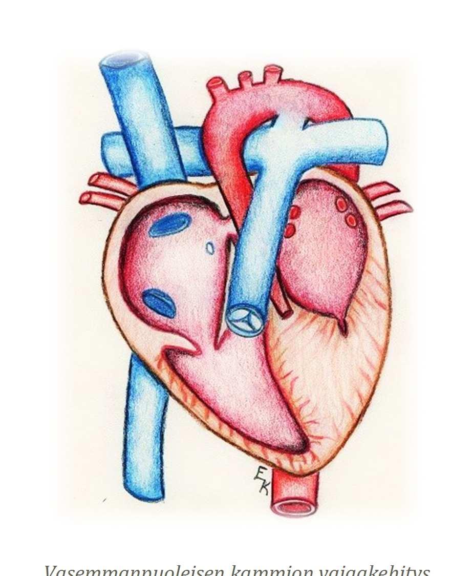Vasemmanpuoleisen kammion vajaakehitys Yksikammioinen sydän ja sen hoito Yksikammioisuus on sydämen rakenteellinen vika, jossa toinen sydämen kammioista on alikehittynyt tai puuttuu kokonaan.