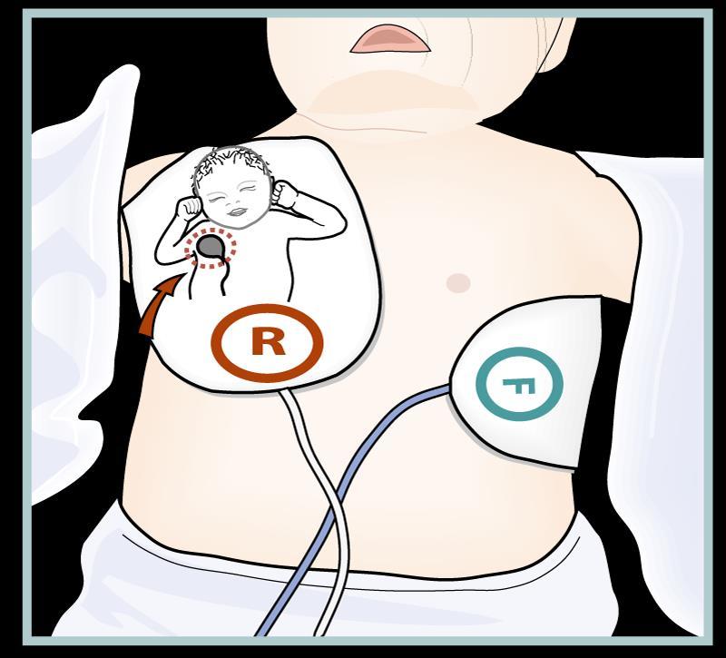 30 Kuva 1. Defibrillaattorin elektrodien asetus (Suominen 2016). Lapsen hoitoelvytyskaavio on esitetty liitteessä 3.