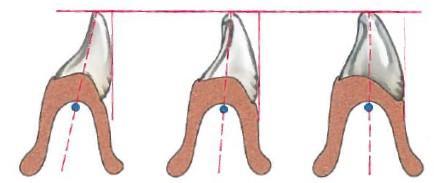 Etuhampaiden asettelussa voidaan soveltaa myös yksilöllistä asettelua, jolloin hampaita voidaan kääntää pituusakseleidensa ympäri.