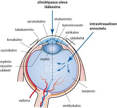 12 Suora laserhoito oli aiemmin ainoa silmänpohjan kosteaan ikärappeumaan saatavilla ollut hoitomuoto.