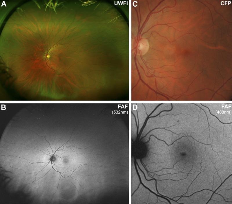 Normaali autofluoresenssi Ly A, Nivison-Smith L, Assaad N, Kalloniatis M.