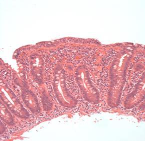 Murtumariski ja pysyvä villusatrofia gluteenittomasta dieetistä huolimatta n= 7,146 patients with coeliac disease and a follow-up biopsy 43% had persistent villous atrophy (adherence to gluten-free