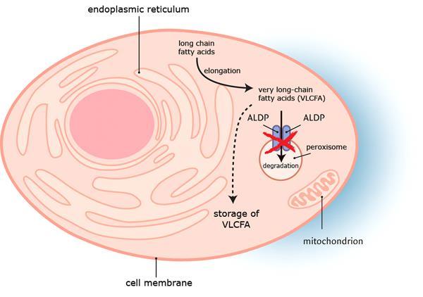 X-kromosomaalinen adrenoleukodystrofia (X-ALD) Yleisin peroksisomitauti 1:20 000, ABCD1 mutaatio http://www.x-ald.