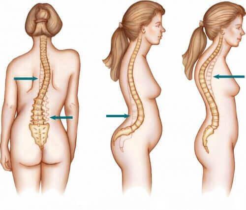 7 2 SKOLIOOSI Skolioosilla tarkoitetaan selän vinoutumista sivusuuntaan (Helenius 2015), ja se on yksi tavallisimpia lapsuus- ja nuoruusiässä ilmeneviä selkärangan epämuodostumia.