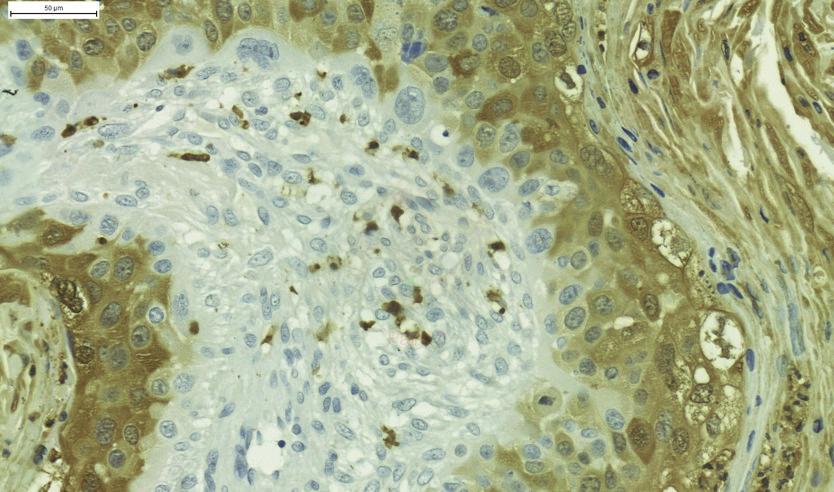 Review of literature Figure 5. MAC387 staining in bladder cancer tissue. Little black arrow shows macrophage staining, big open arrow shows squamous differentiation. Scale bar 50µm. 4.