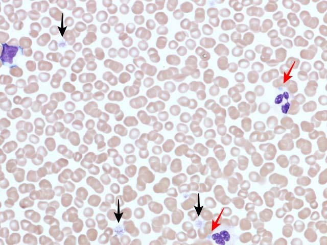 37 Albers CA, Newbury-Ecob R, Ouwehand WH, Ghevaert C. New insights into the genetic basis of TAR (thrombocytopenia-absent radii) syndrome. Curr Opin Genet Dev 2013;23:316 23.