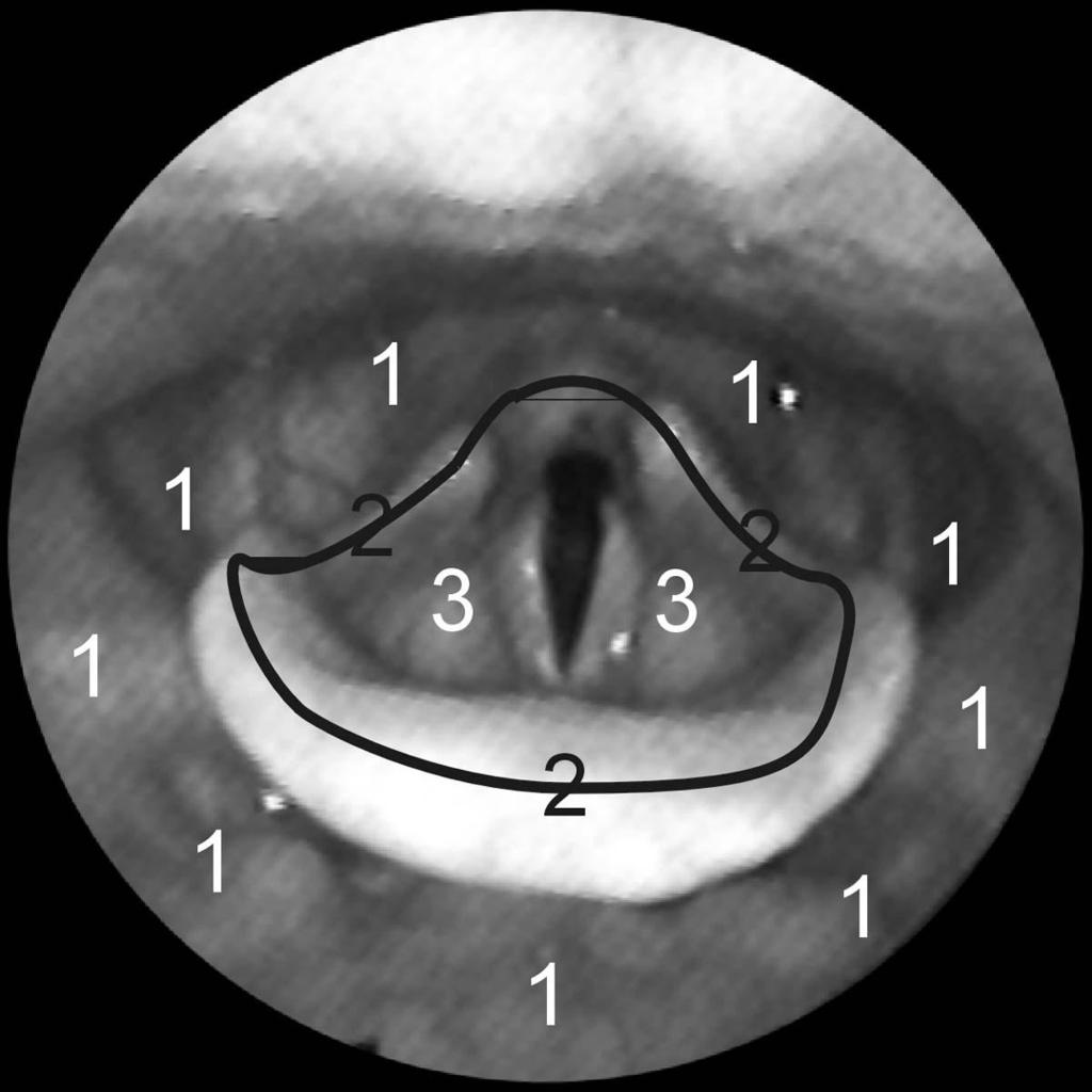 Hypofarynksin tarkastelu: Alueet 2 ja 3 laryngeal rim, laryngeal vestibule ; millainen sensoriikka ja motoriset vasteet?