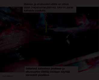 Peräsuoli ja virtsarakko vedetään irti erityistä huolellisuutta noudattaen. Ruoansulatuskanavan kannatinkalvot irrotetaan ja ruokatorvi vedetään pallean läpi vatsaontelon puolelle.