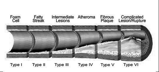 9 and plaque shoulder areas after physical disruption or erosion, when the inner procoagulant material of the plaque is exposed to thrombotic factors in the bloodstream, triggering thrombosis