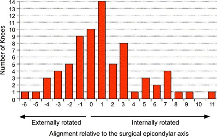 TEA:N MÄÄRITYS MENEE ORTOPEDILTA VÄÄRIN JOKA NELJÄNNELLÄ POTILAALLA Kinzel et al. Can the epicondylar axis be defined accurately in total knee arthroplasty?